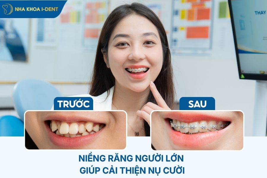 niềng răng người lớn