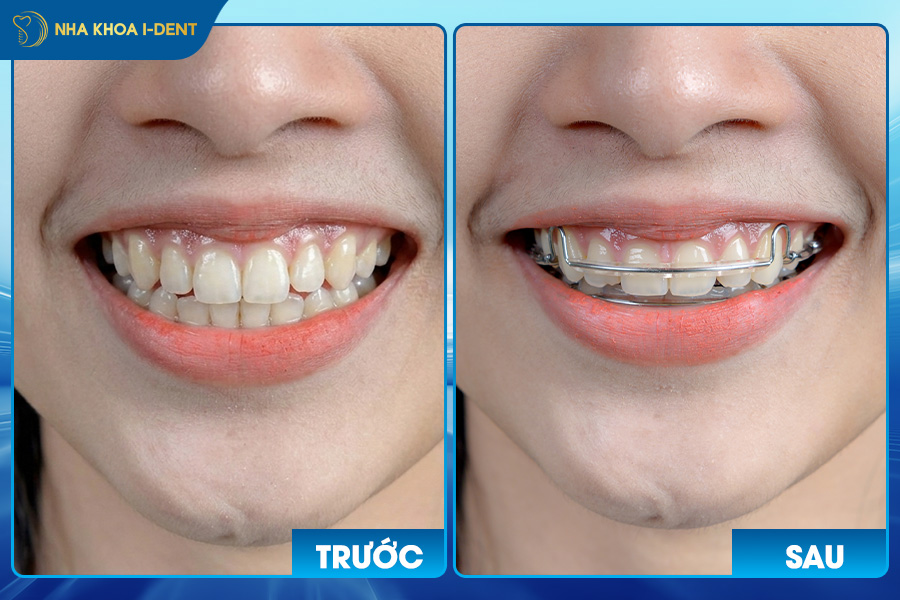 niềng răng sau 1 tháng