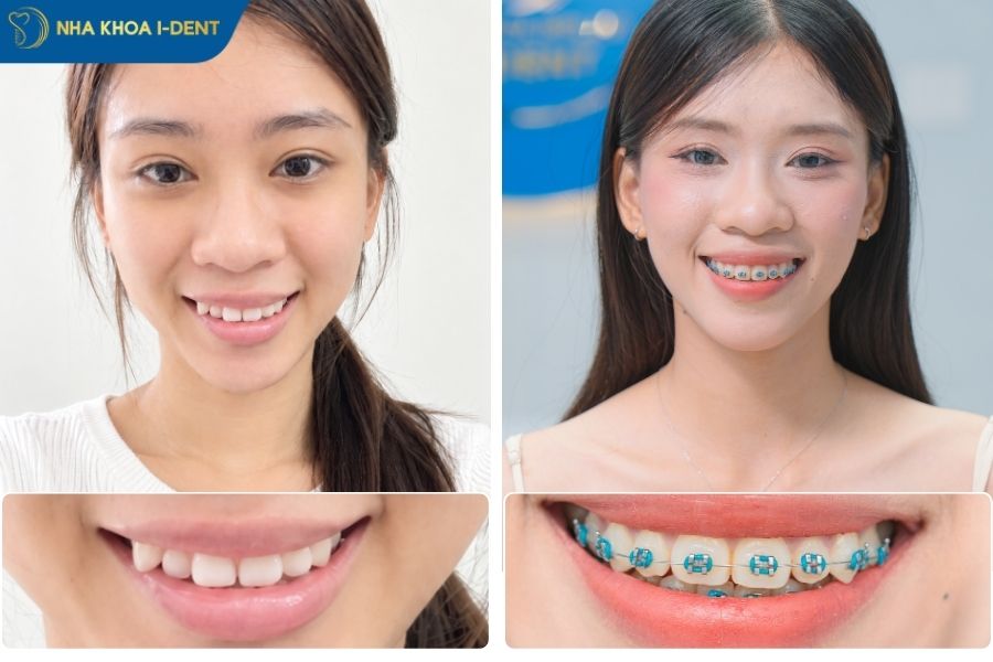 niềng răng thay đổi khuôn mặt