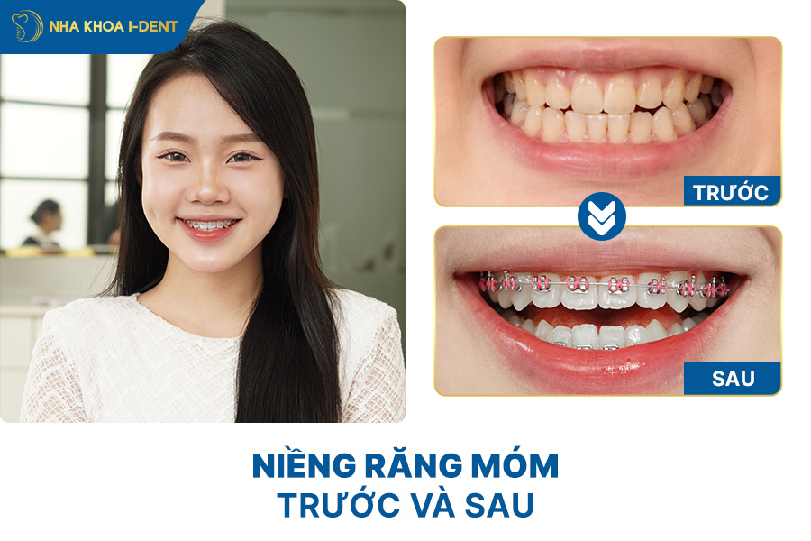 niềng răng trong suốt cho răng móm