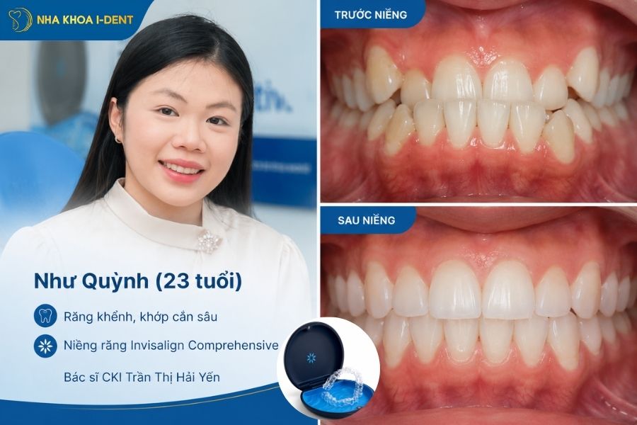 Niềng răng trong suốt loại nào tốt nhất