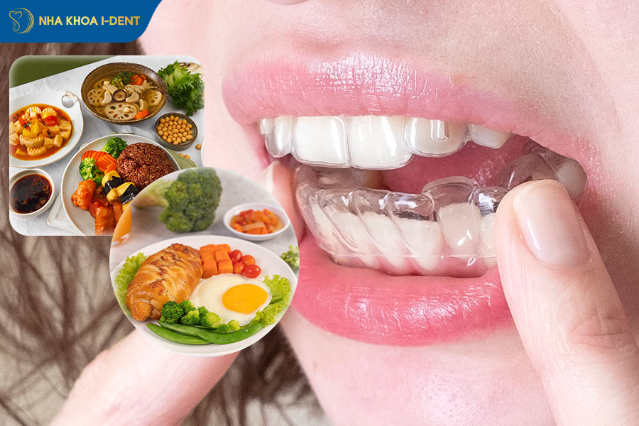 nên niềng răng trong suốt hay mắc cài