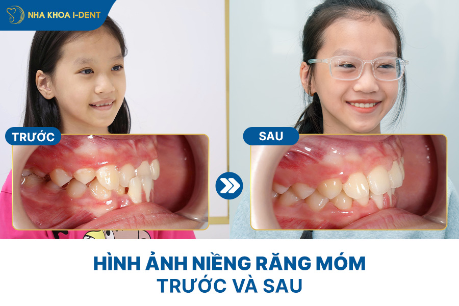 niềng răng trước và sau
