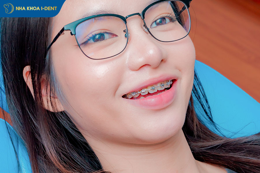 niềng răng xong vẫn xấu