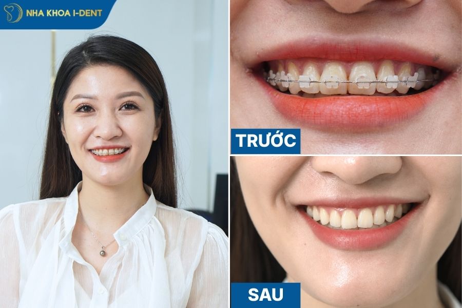 phương pháp niềng răng