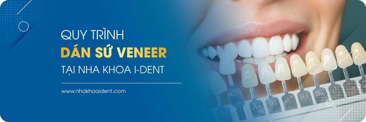 Quy trình dán sứ Veneer chuẩn Y khoa tại nha khoa I-Dent.