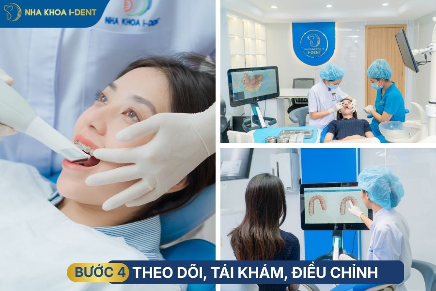 quy trình của niềng răng khớp cắn sâu