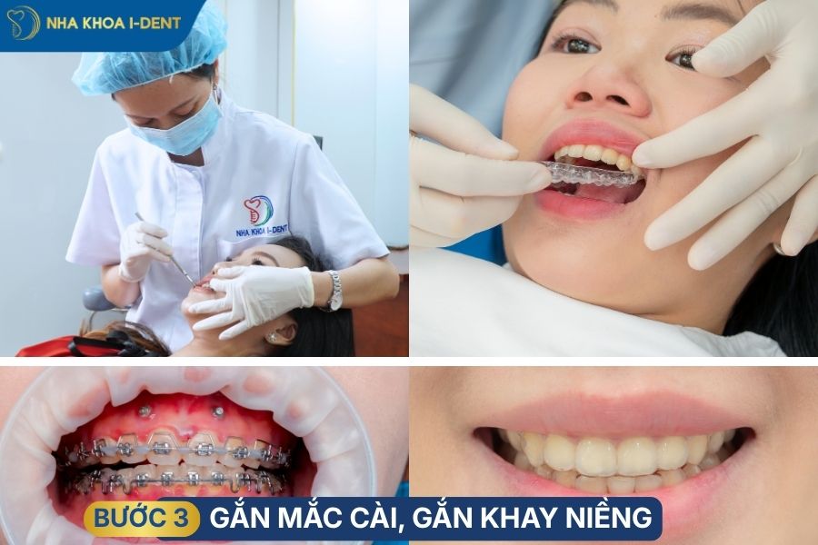 quy trình niềng răng khớp cắn sâu