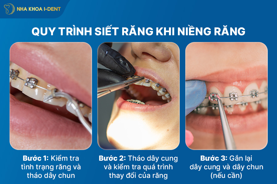 quy trình siết răng khi niềng răng