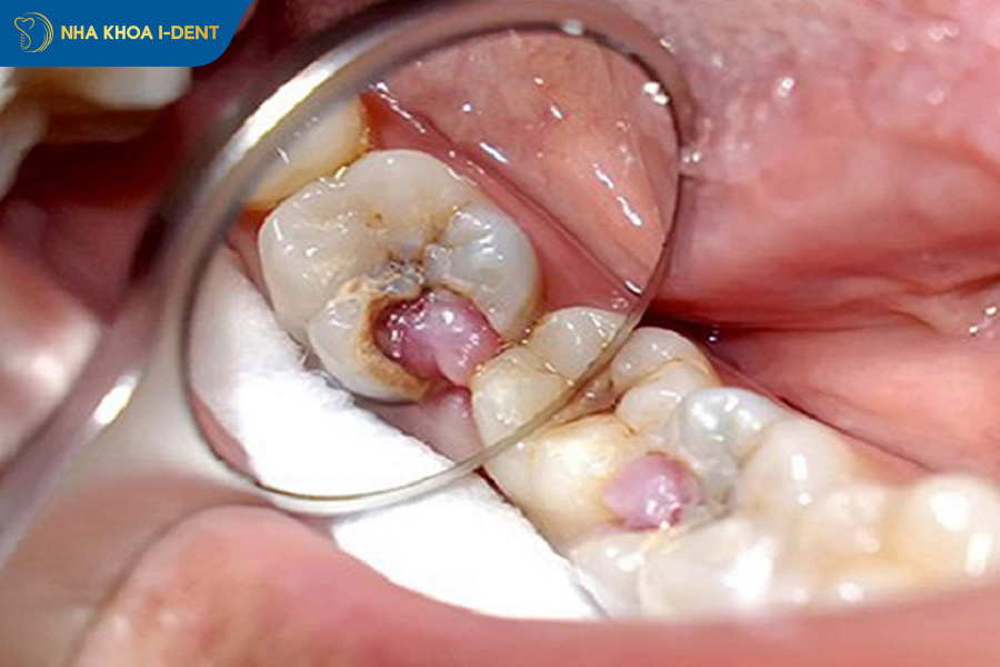 răng đã lấy tủy bọc sứ được bao lâu