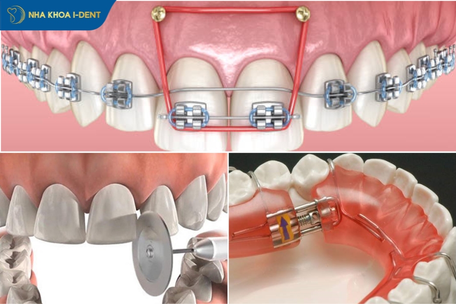 niềng răng hô nhẹ có phải nhổ răng không