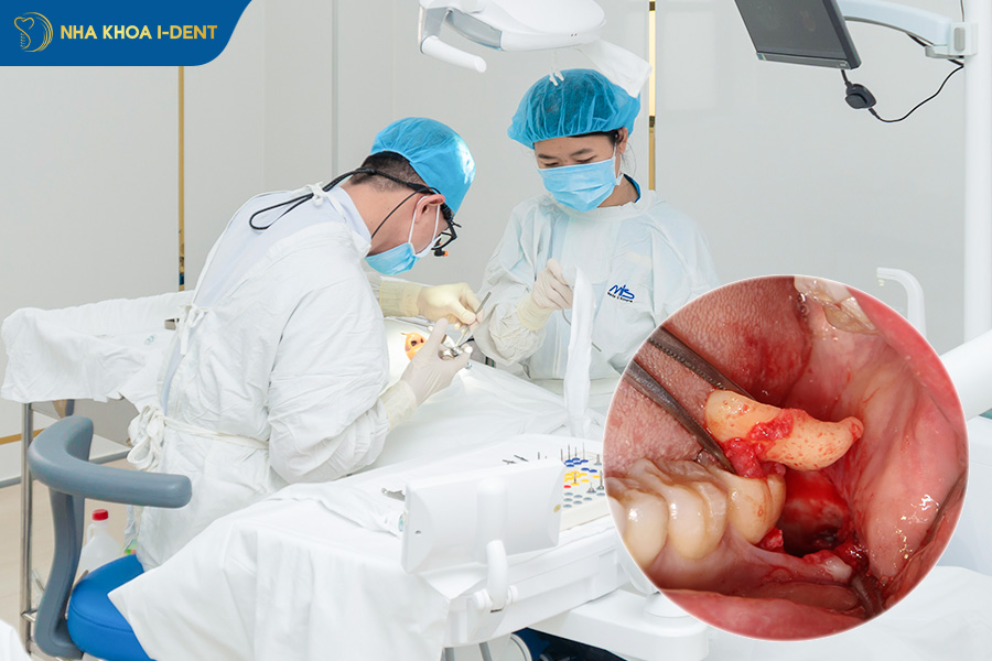 Răng khôn có cần phải nhổ không