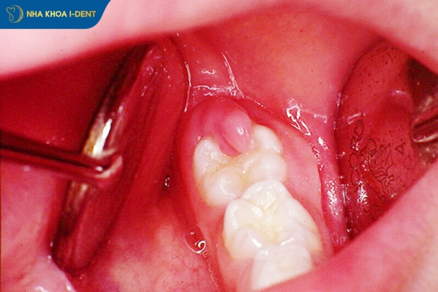 răng khôn đang đau có nhổ được không