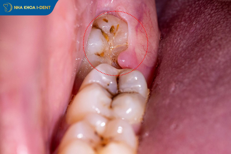 răng khôn không nhổ có sao không