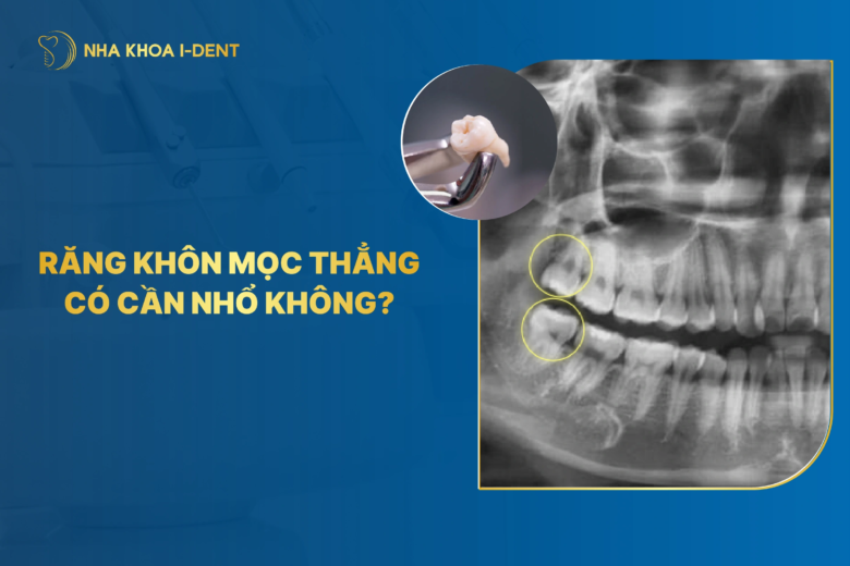 Răng khôn mọc thẳng có cần nhổ không? 