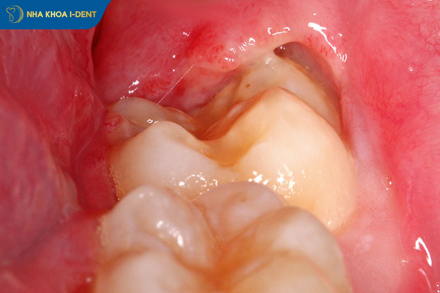 răng khôn mọc thẳng có cần nhổ