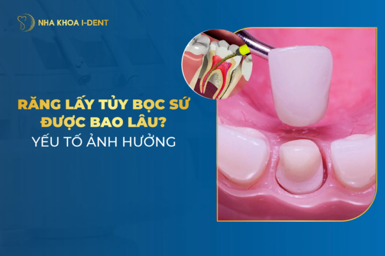 Răng lấy tủy bọc sứ được bao lâu? Yếu tố ảnh hưởng