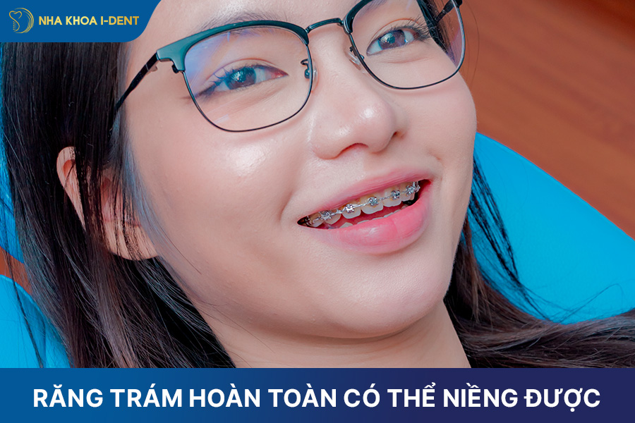 răng trám có niềng được không
