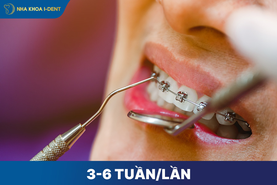 siết răng khi niềng có đau không