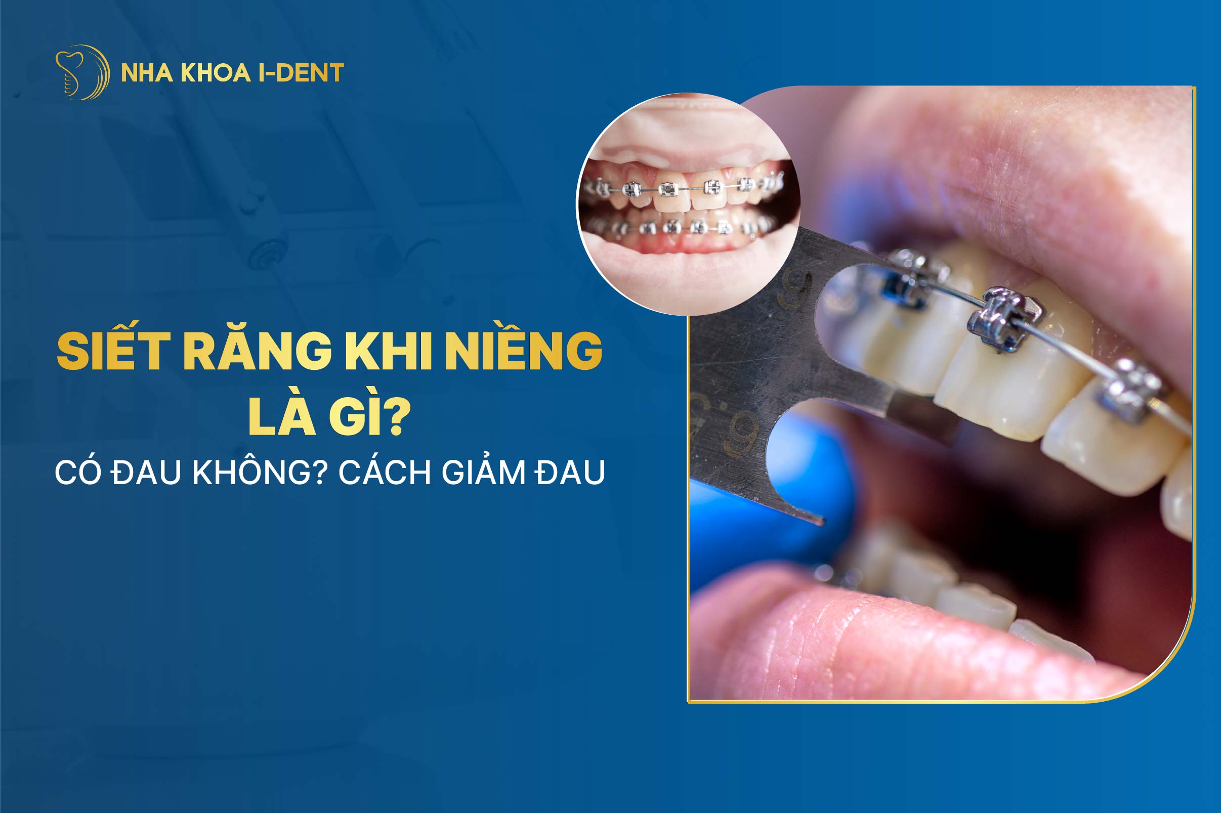 Siết răng khi niềng răng là gì? Đau không? Cách giảm đau