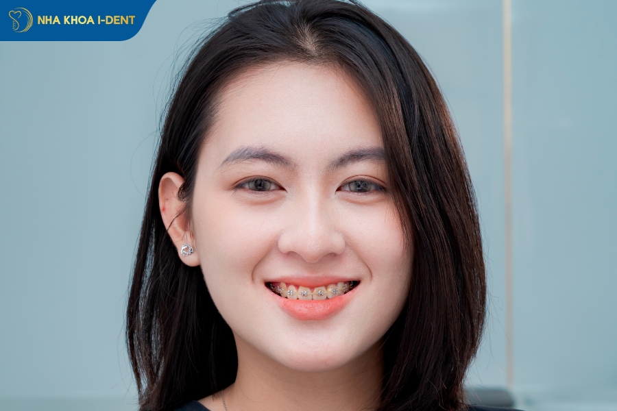 lợi ích của niềng răng