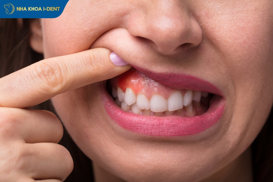 tác dụng niềng răng