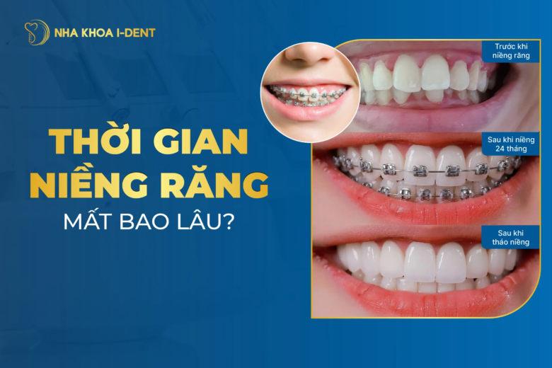 Thời Gian Niềng Răng Mất Bao Lâu Thì Kết Thúc?