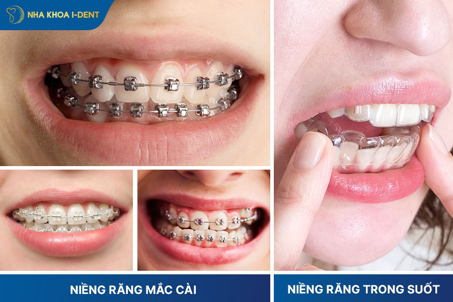 phương pháp niềng răng nhanh