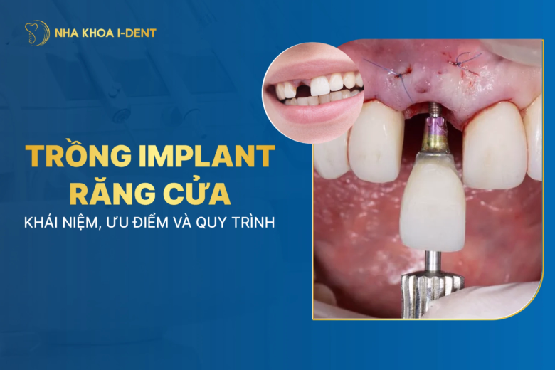 trồng implant răng cửa