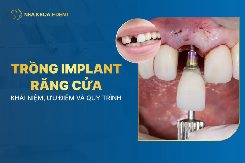 Trồng implant răng cửa: Khái niệm, ưu điểm, quy trình và giá