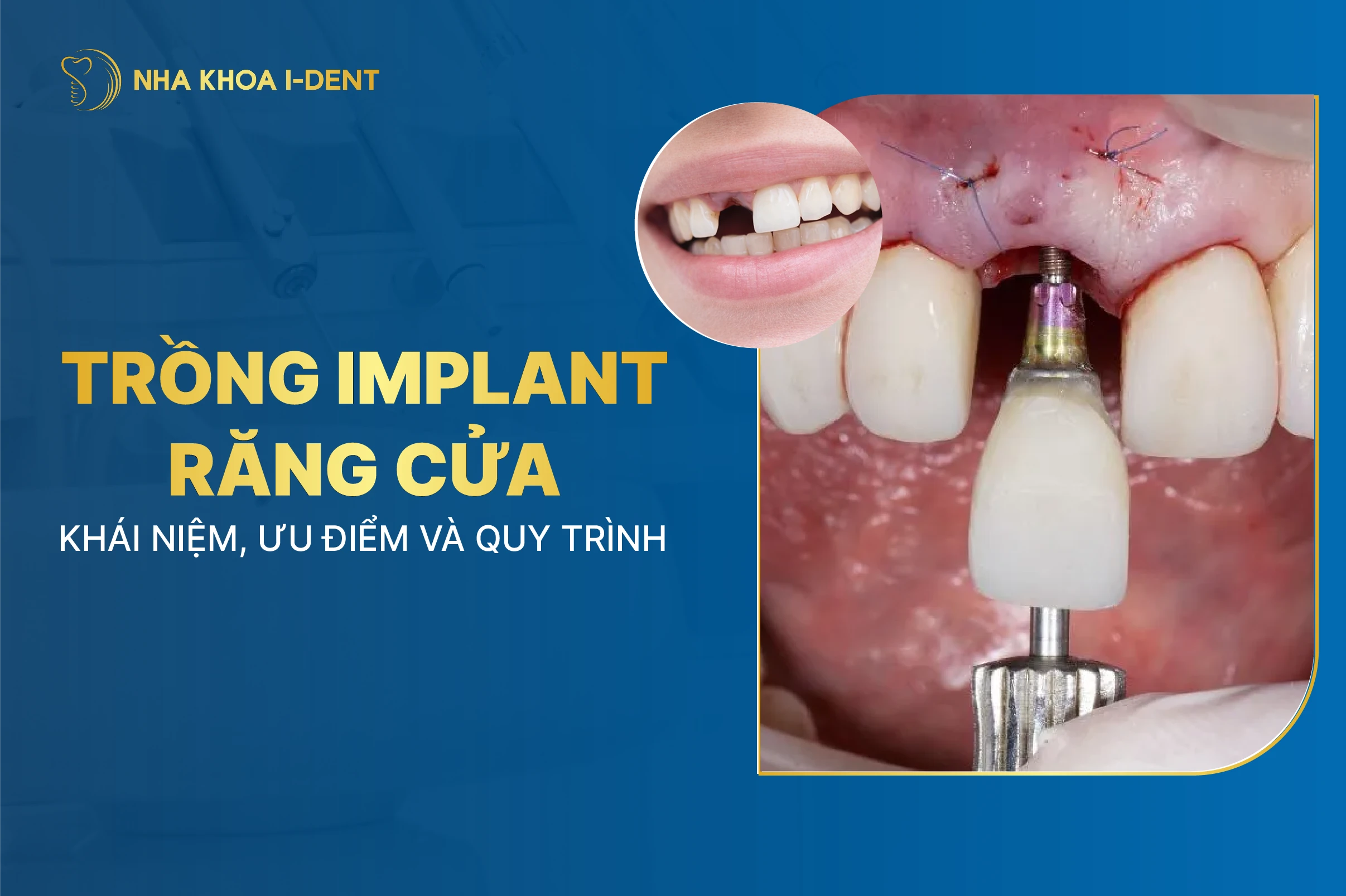Trồng implant răng cửa: Khái niệm, ưu điểm, quy trình và giá