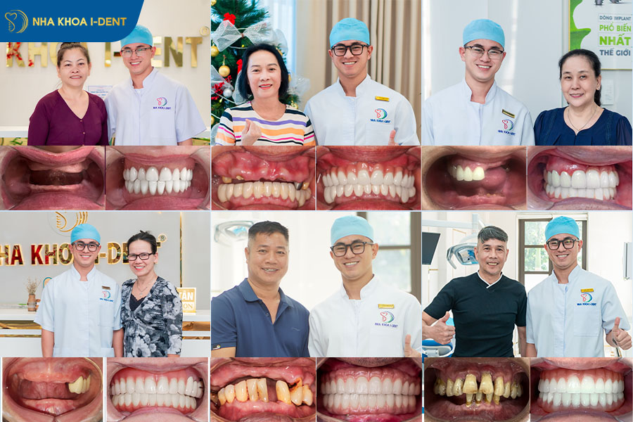 trụ implant đức có tốt không