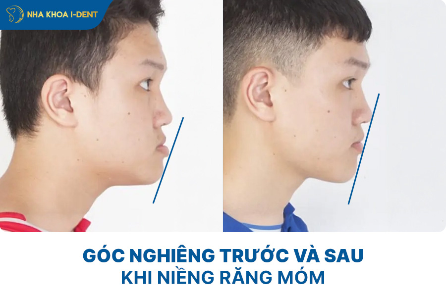 trước và sau khi niềng răng móm