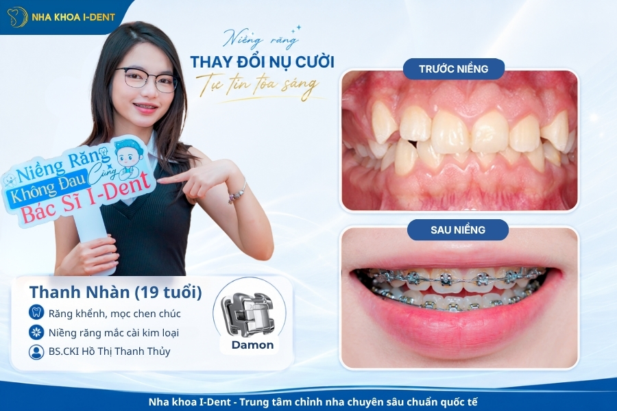 Phương pháp niềng răng mắc cài kim loại có giá thấp nhất