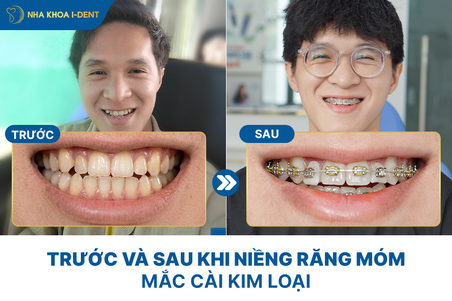 trước và sau niềng răng