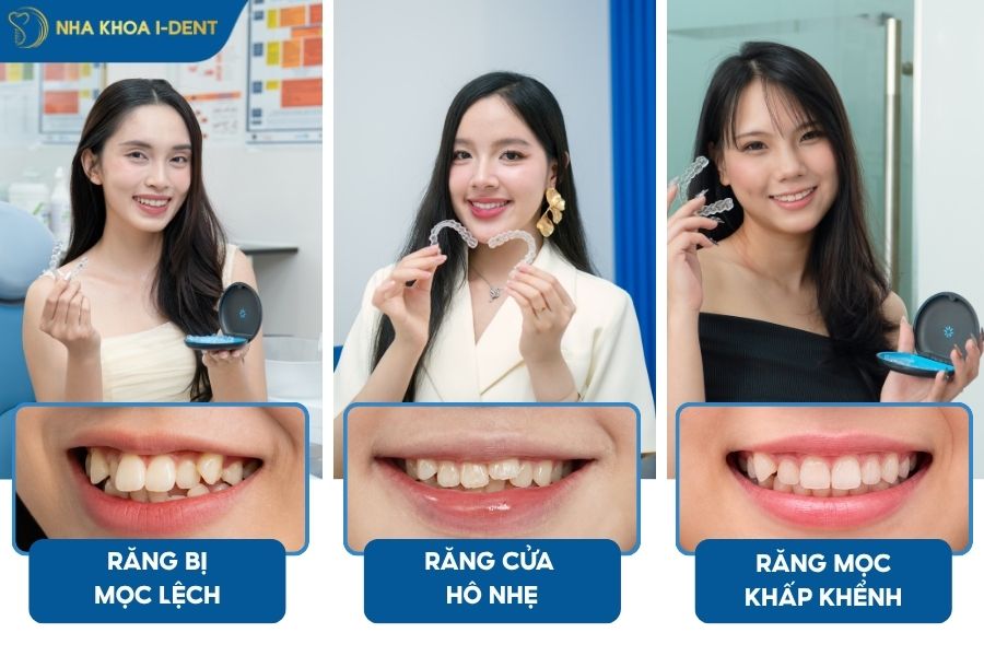 niềng răng không mắc cài - truong-hop-nieng-rang-khong-ma