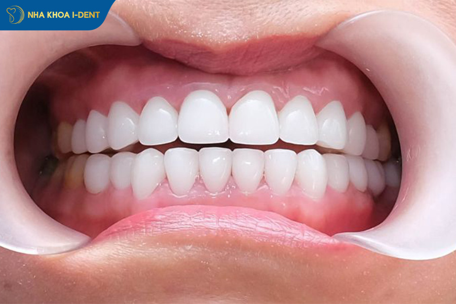 tuổi thọ răng lấy tủy