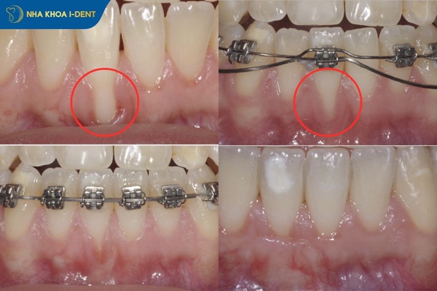 tụt nướu khi niềng răng