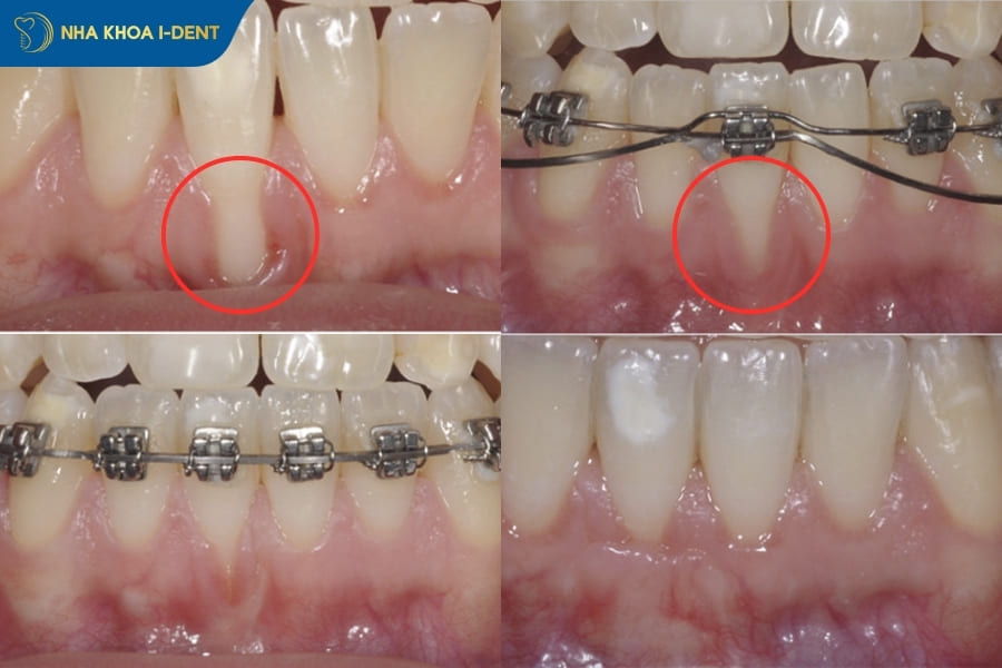 niềng răng có bị tụt lợi