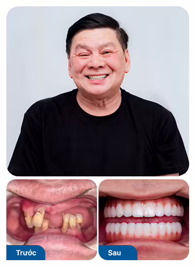 Bệnh nhân trồng răng implant toàn hàm tại nha khoa I-Dent.