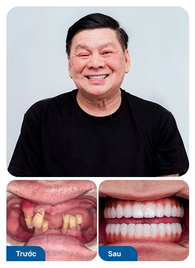 Bệnh nhân trồng răng implant toàn hàm tại nha khoa I-Dent.