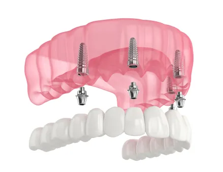 Trồng răng implant toàn hàm All-on-4 tại nha khoa I-Dent.