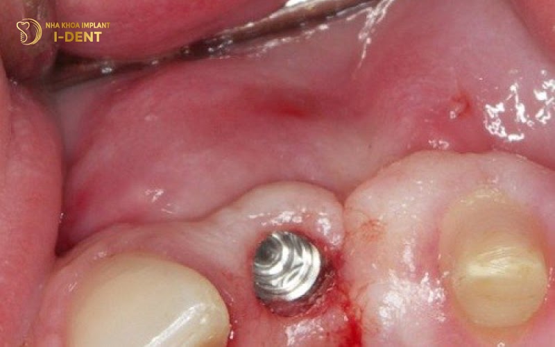 vùng cấy implant bị nhiễm trùng