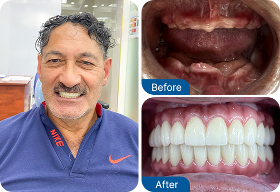 full set of dental implants