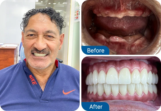 full set of dental implants