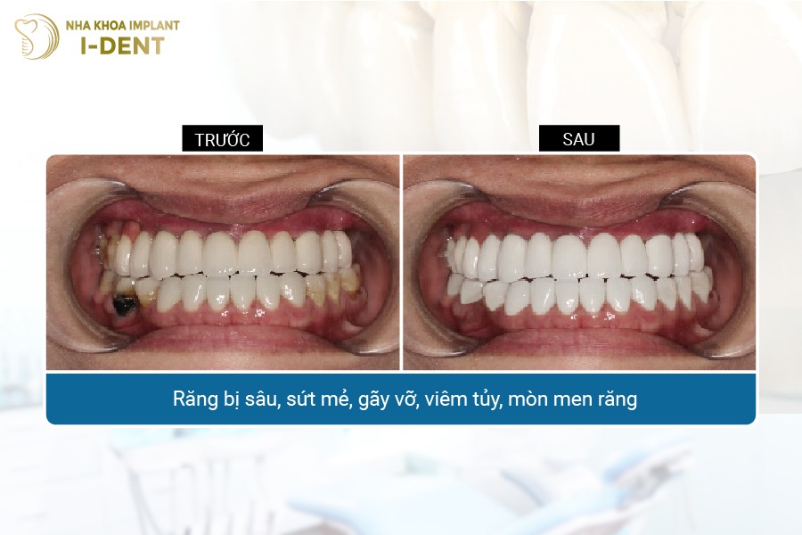 Hình ảnh khách hàng trước và sau khi bọc răng sứ tại Nha khoa I-DENT