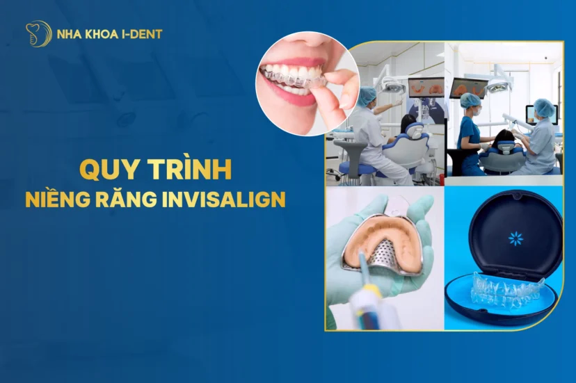 8 bước quy trình niềng răng trong suốt Invisalign
