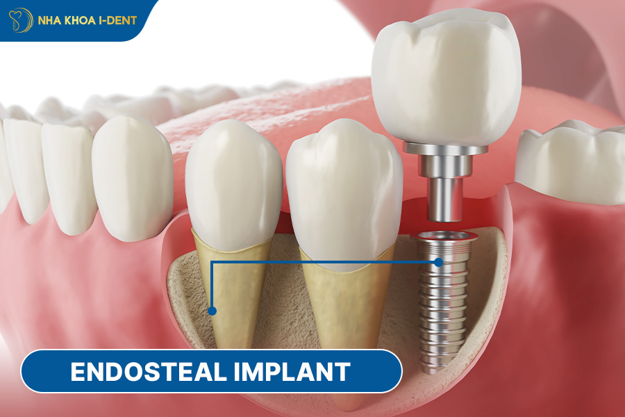 affordable dental implants