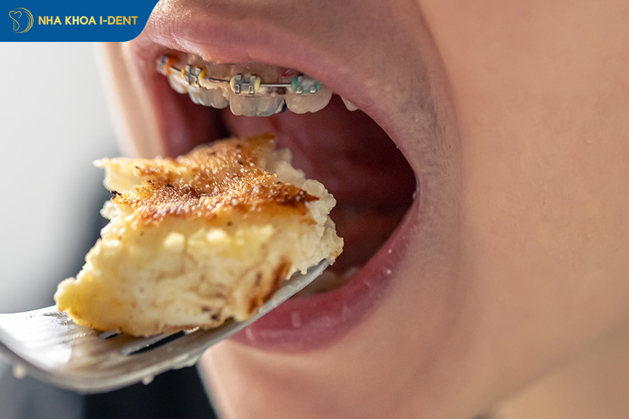 Chú ý đến chế độ ăn uống để tránh làm bung mắc cài