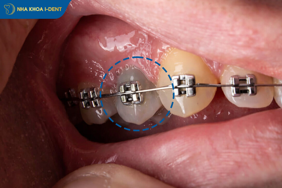 dấu hiệu bị đau hàm và răng chết tủy